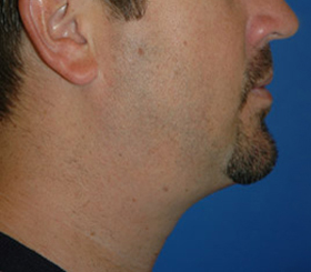 images/neck-liposuction-2.jpg